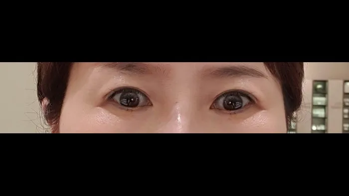 Sub-brow Lift — RE&RE PLASTIC SURGERY 6
