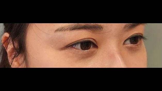 Incisional Double Eyelid Surgery, Lower Eyelid Fat Grafting — RE&RE PLASTIC SURGERY 1