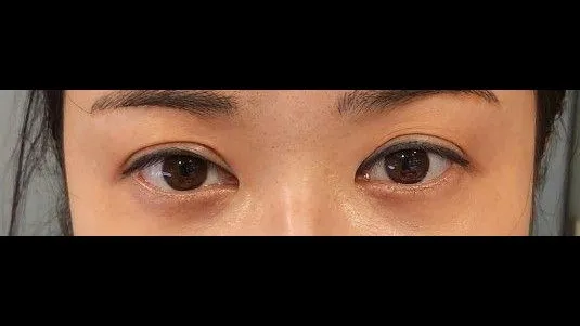 Incisional Double Eyelid Surgery, Lower Eyelid Fat Grafting — RE&RE PLASTIC SURGERY 2