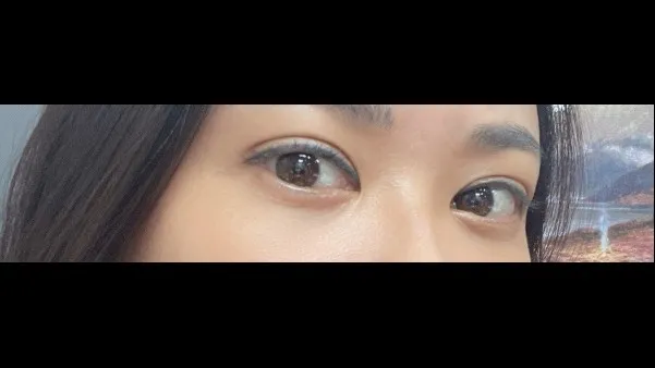 Incisional Double Eyelid Surgery, Lower Eyelid Fat Grafting — RE&RE PLASTIC SURGERY 3