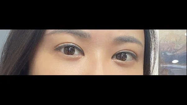 Incisional Double Eyelid Surgery, Lower Eyelid Fat Grafting — RE&RE PLASTIC SURGERY 4