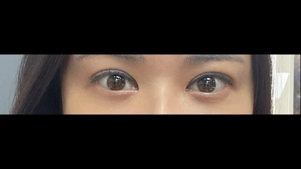 Incisional Double Eyelid Surgery, Lower Eyelid Fat Grafting — RE&RE PLASTIC SURGERY 5