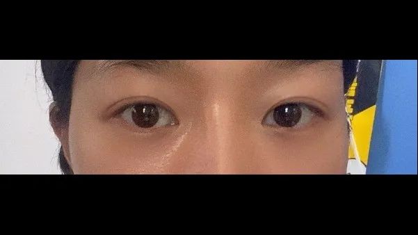 Natural Adhesion Double Eyelid Surgery — RE&RE PLASTIC SURGERY 2