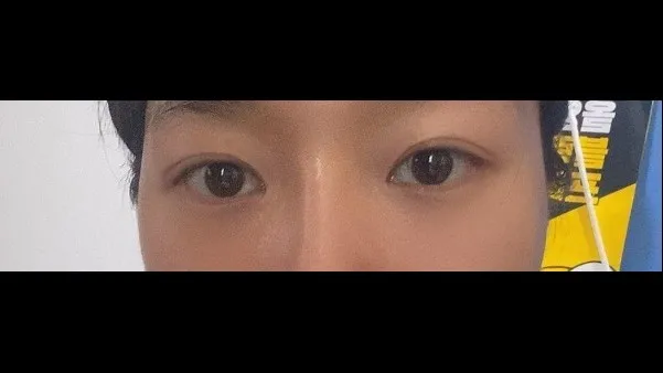 Natural Adhesion Double Eyelid Surgery — RE&RE PLASTIC SURGERY 3