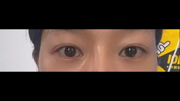 Natural Adhesion Double Eyelid Surgery — RE&RE PLASTIC SURGERY 4