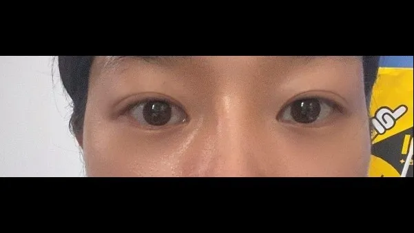 Natural Adhesion Double Eyelid Surgery — RE&RE PLASTIC SURGERY 5