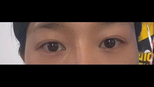 Natural Adhesion Double Eyelid Surgery — RE&RE PLASTIC SURGERY 6