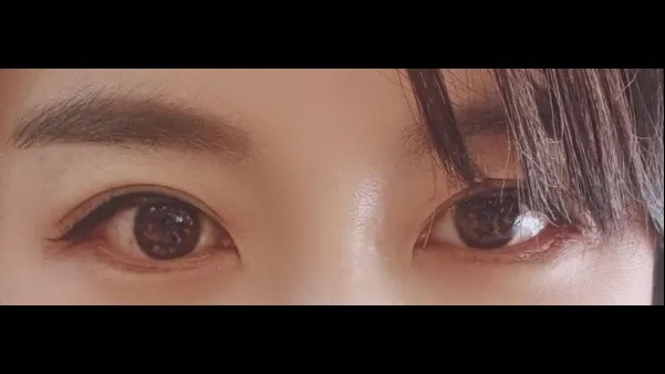 Incisional Double Eyelid Surgery, Lower Eyelid Fat Grafting — RE&RE PLASTIC SURGERY 2