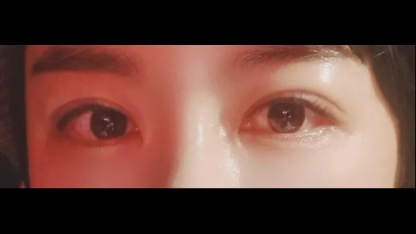 Incisional Double Eyelid Surgery, Lower Eyelid Fat Grafting — RE&RE PLASTIC SURGERY 4
