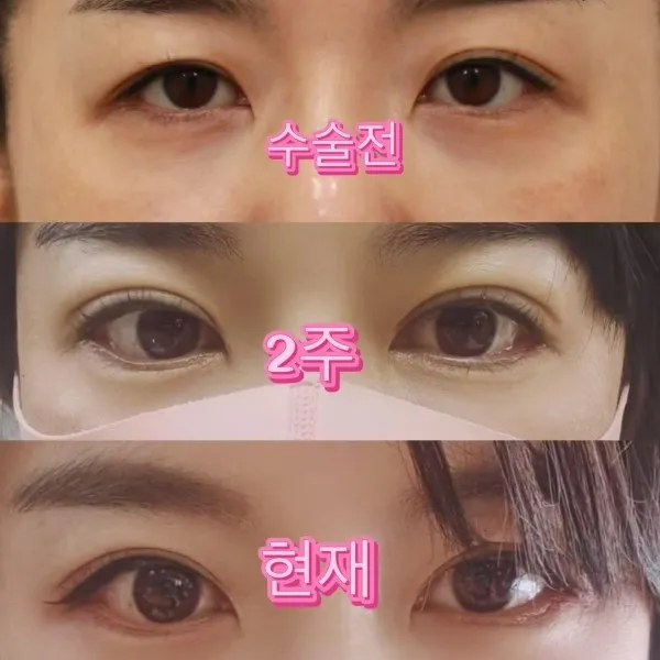 Incisional Double Eyelid Surgery, Lower Eyelid Fat Grafting — RE&RE PLASTIC SURGERY 5