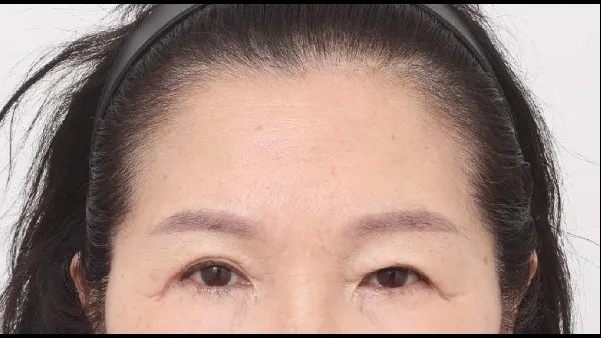 Partial Incision Double Eyelid Surgery, Forehead Lift, Sub-brow Lift 1