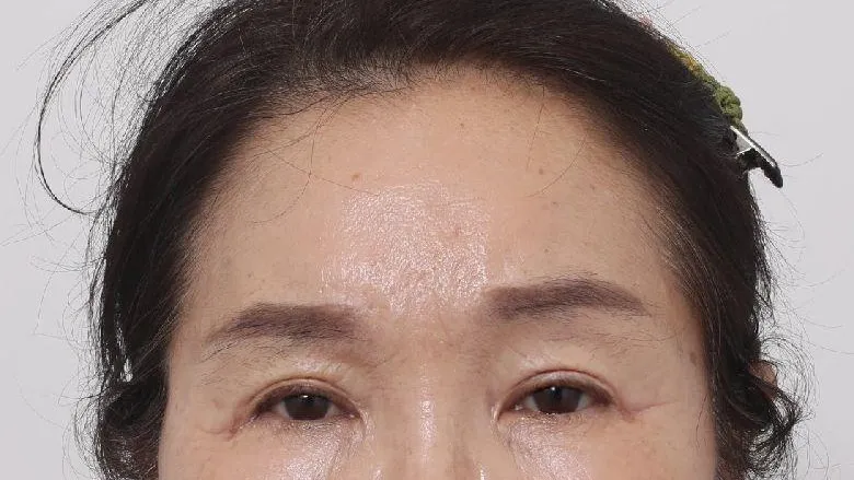 Partial Incision Double Eyelid Surgery, Forehead Lift, Sub-brow Lift 2