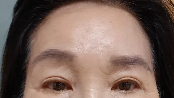 Partial Incision Double Eyelid Surgery, Forehead Lift, Sub-brow Lift — RE&RE PLASTIC SURGERY 3