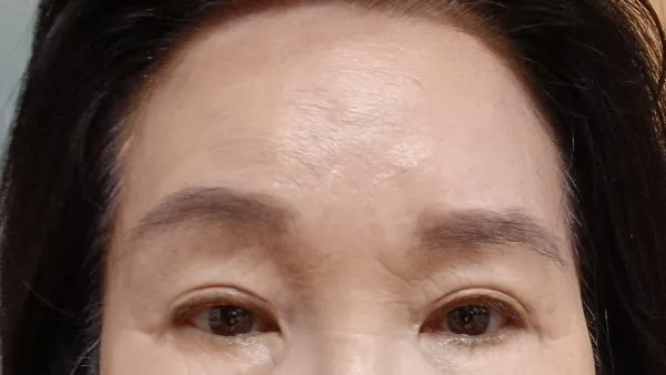 Partial Incision Double Eyelid Surgery, Forehead Lift, Sub-brow Lift — RE&RE PLASTIC SURGERY 4
