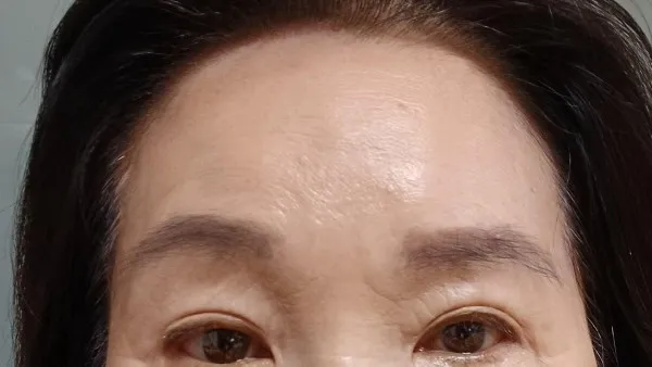 Partial Incision Double Eyelid Surgery, Forehead Lift, Sub-brow Lift — RE&RE PLASTIC SURGERY 5