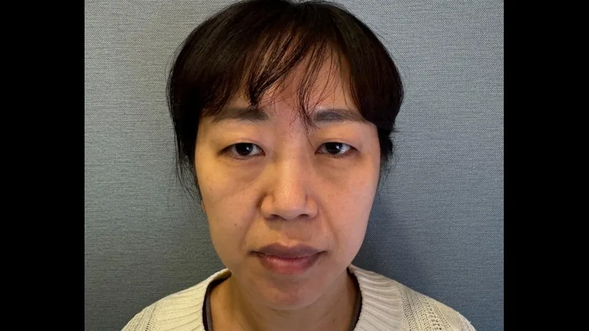 Sub-brow Lift, Facial Fat Grafting 1
