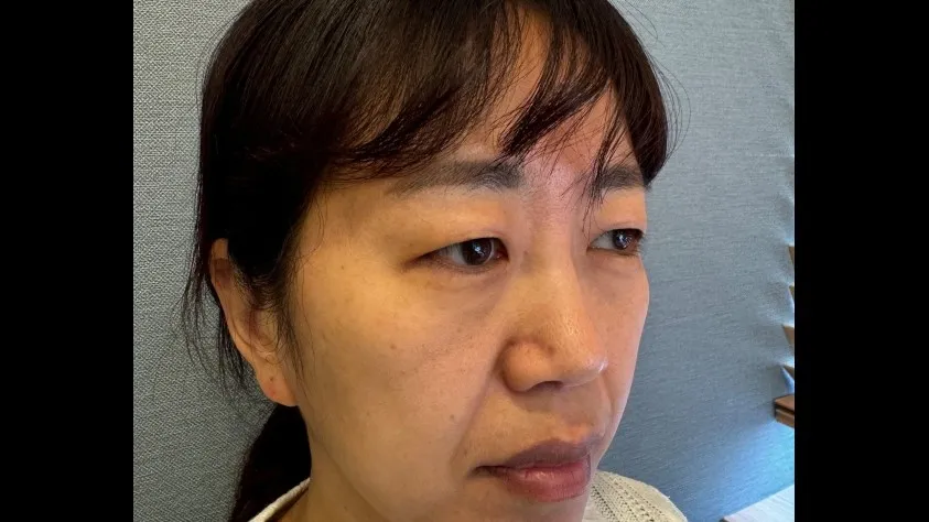 Sub-brow Lift, Facial Fat Grafting — RE&RE PLASTIC SURGERY 2