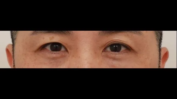 Incisional Double Eyelid Surgery, Ptosis Correction — RE&RE PLASTIC SURGERY 1