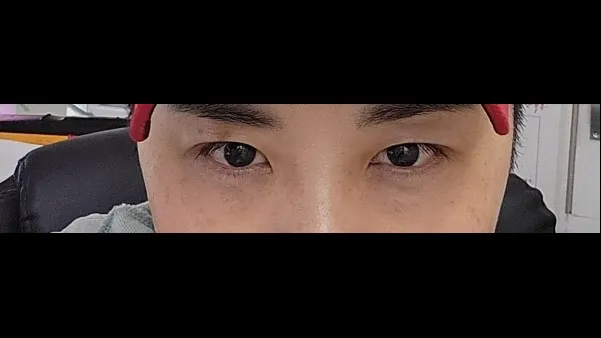 Incisional Double Eyelid Surgery, Ptosis Correction — RE&RE PLASTIC SURGERY 2