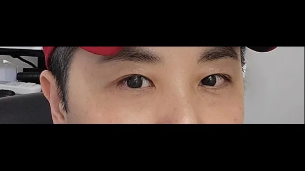 Incisional Double Eyelid Surgery, Ptosis Correction — RE&RE PLASTIC SURGERY 3