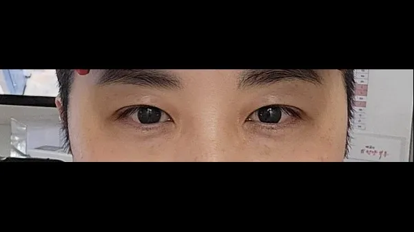 Incisional Double Eyelid Surgery, Ptosis Correction — RE&RE PLASTIC SURGERY 4