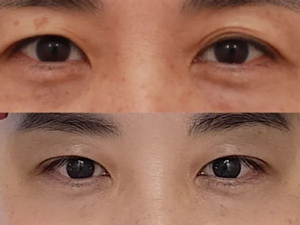 Incisional Double Eyelid Surgery, Ptosis Correction — RE&RE PLASTIC SURGERY 5