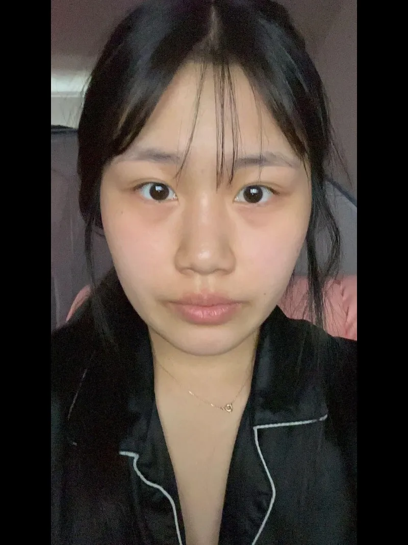 Partial Incision Double Eyelid Surgery, Ptosis Correction, Lower Eyelid Fat Grafting, Nasal Bridge, Nasal Tip 1