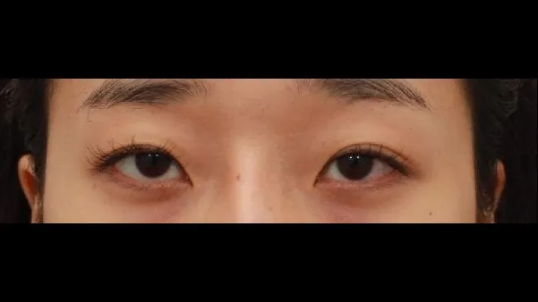 Natural Adhesion Double Eyelid Surgery, Ptosis Correction, Facial Fat Grafting 1
