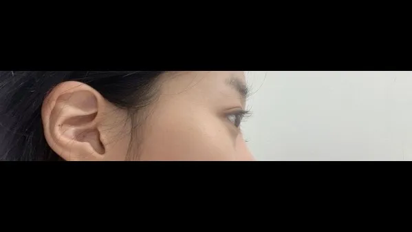 Natural Adhesion Double Eyelid Surgery, Ptosis Correction, Facial Fat Grafting — RE&RE PLASTIC SURGERY 4