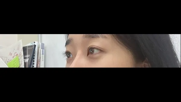Natural Adhesion Double Eyelid Surgery, Ptosis Correction, Facial Fat Grafting — RE&RE PLASTIC SURGERY 5