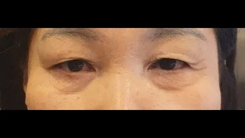 Sub-brow Lift, Lower Blepharoplasty (Aging Eye Rejuvenation), Midface Lift, Full facelift 1