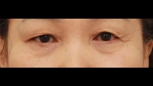 眉下リフト, 下眼瞼形成（中高年の目元）, 中顔面リフト, フルフェイスリフト 2