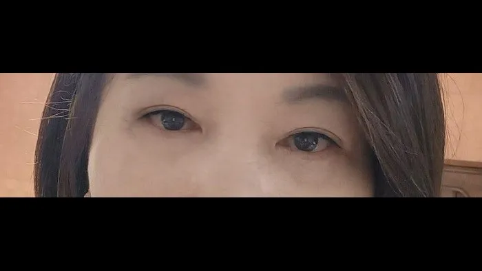 眉下リフト, 下眼瞼形成(中高年の目元), 中顔面リフト, フルフェイスリフト — RE&RE PLASTIC SURGERY 5