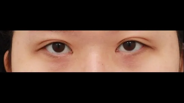 切開法(二重), ラインを低くする — RE&RE PLASTIC SURGERY 1