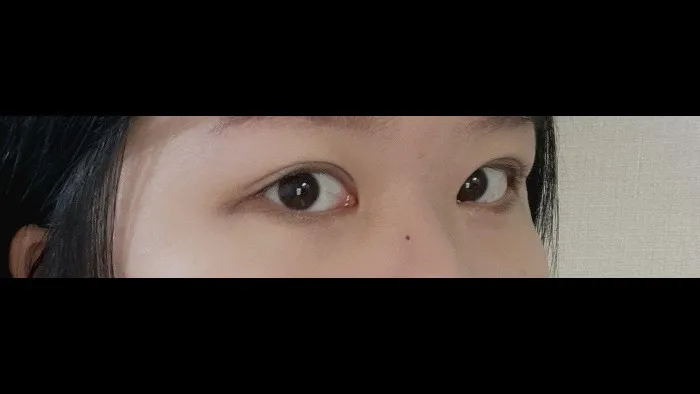 Incisional Double Eyelid Surgery, Crease lowering 2
