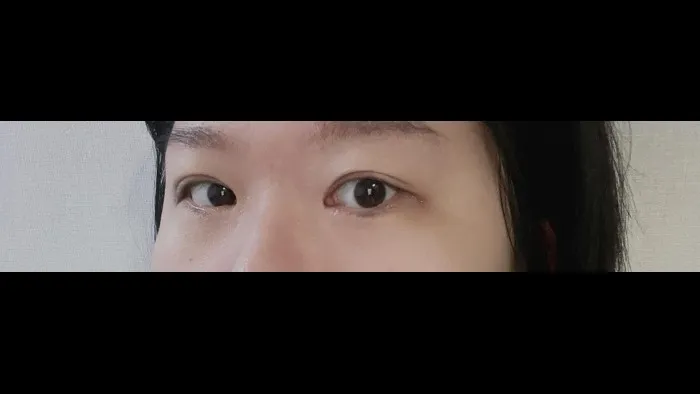 切開法(二重), ラインを低くする — RE&RE PLASTIC SURGERY 3