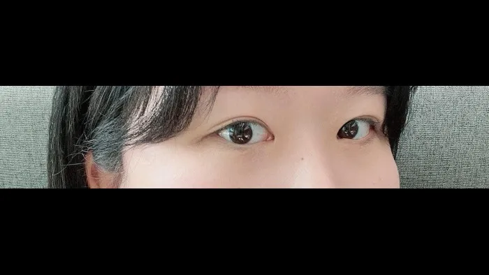 切開法(二重), ラインを低くする — RE&RE PLASTIC SURGERY 4