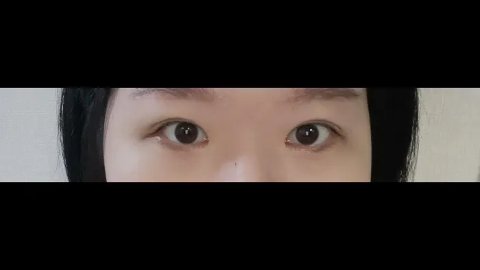 切開法(二重), ラインを低くする — RE&RE PLASTIC SURGERY 6