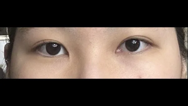 Incisional Double Eyelid Surgery, Ptosis Correction — RE&RE PLASTIC SURGERY 2