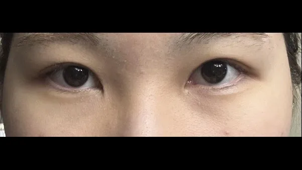 Incisional Double Eyelid Surgery, Ptosis Correction — RE&RE PLASTIC SURGERY 3