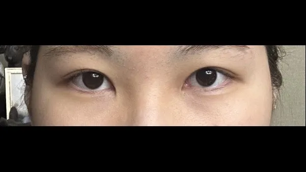 Incisional Double Eyelid Surgery, Ptosis Correction — RE&RE PLASTIC SURGERY 4