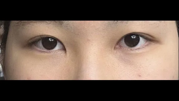 Incisional Double Eyelid Surgery, Ptosis Correction — RE&RE PLASTIC SURGERY 5
