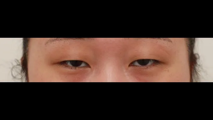 Incisional Double Eyelid Surgery, Ptosis Correction — RE&RE PLASTIC SURGERY 1
