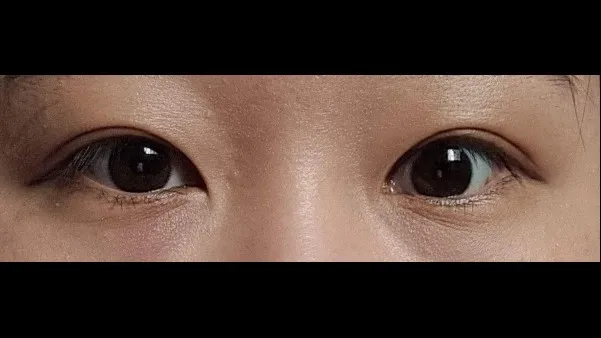 Incisional Double Eyelid Surgery, Ptosis Correction — RE&RE PLASTIC SURGERY 2