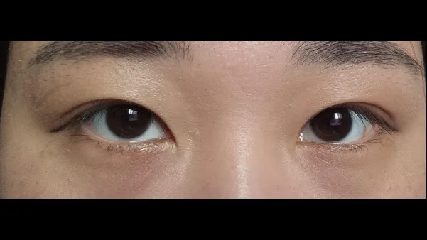 Incisional Double Eyelid Surgery, Ptosis Correction — RE&RE PLASTIC SURGERY 3