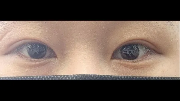Incisional Double Eyelid Surgery, Ptosis Correction — RE&RE PLASTIC SURGERY 4