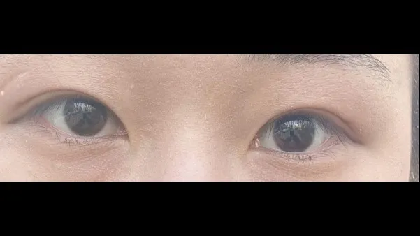 Incisional Double Eyelid Surgery, Ptosis Correction — RE&RE PLASTIC SURGERY 5