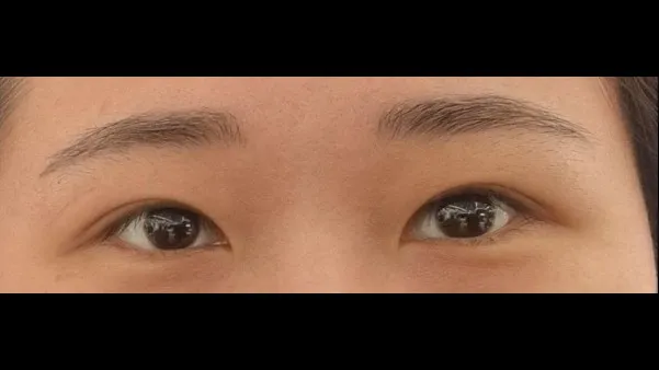 Incisional Double Eyelid Surgery, Ptosis Correction — RE&RE PLASTIC SURGERY 6