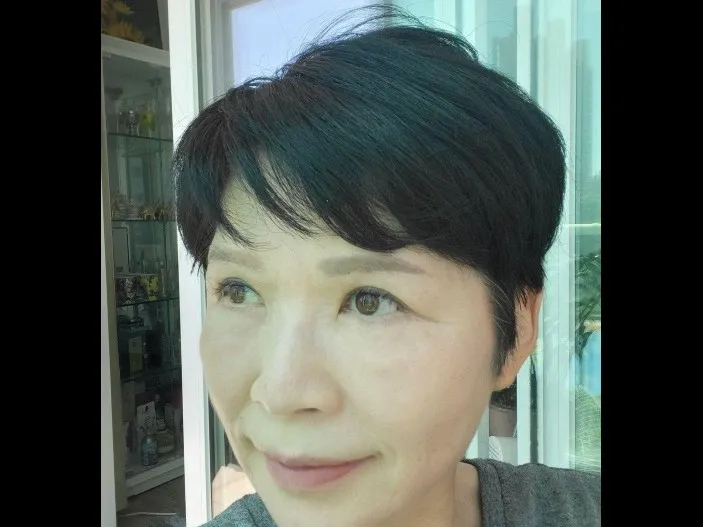 Sub-brow Lift, Lower Blepharoplasty (Aging Eye Rejuvenation) — RE&RE PLASTIC SURGERY 2