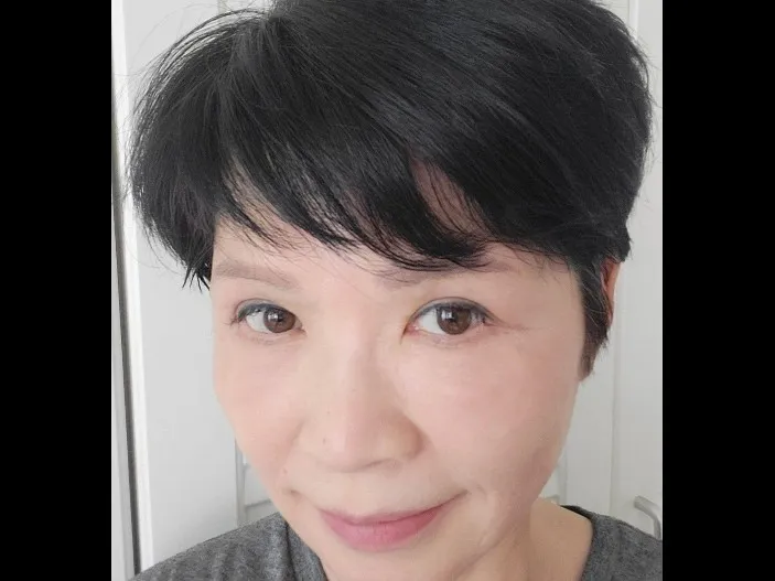 Sub-brow Lift, Lower Blepharoplasty (Aging Eye Rejuvenation) — RE&RE PLASTIC SURGERY 3
